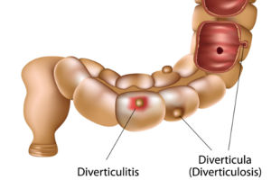 Shéma diverticulite